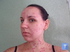 Лечение ветрянки у взрослого.